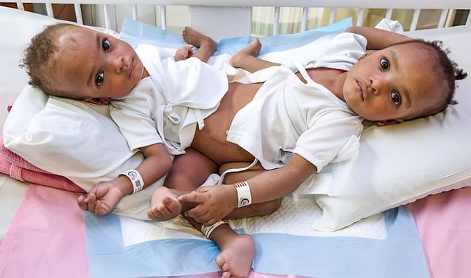 Saudi Arabia’s commitment to medical excellence celebrated as Kingdom marks 34 years of conjoined twins separations