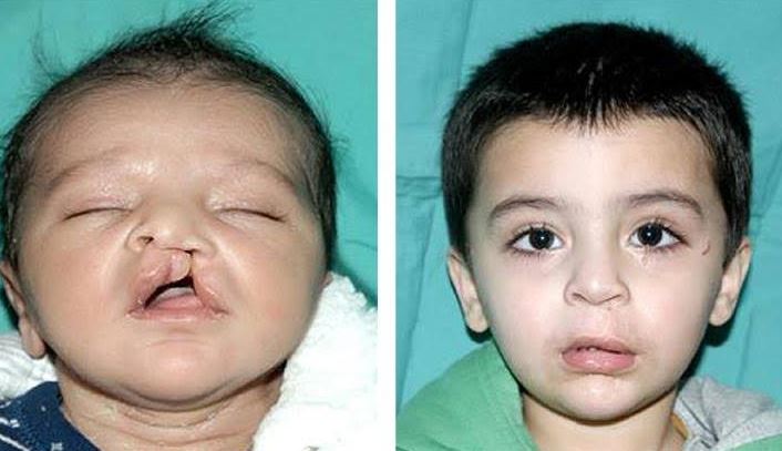 Cleft lip, cleft palate patients to receive free treatment