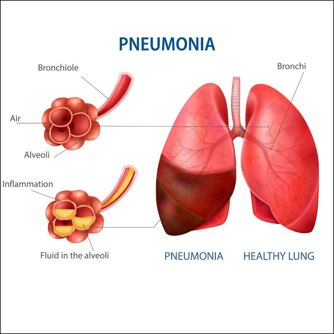 Pneumonia claims six more lives in Punjab