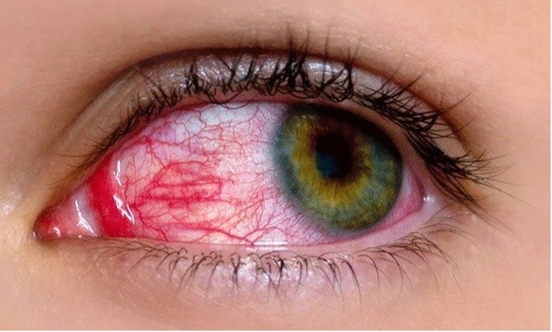 Pink eye cases surge in Lahore: 85 new infections reported