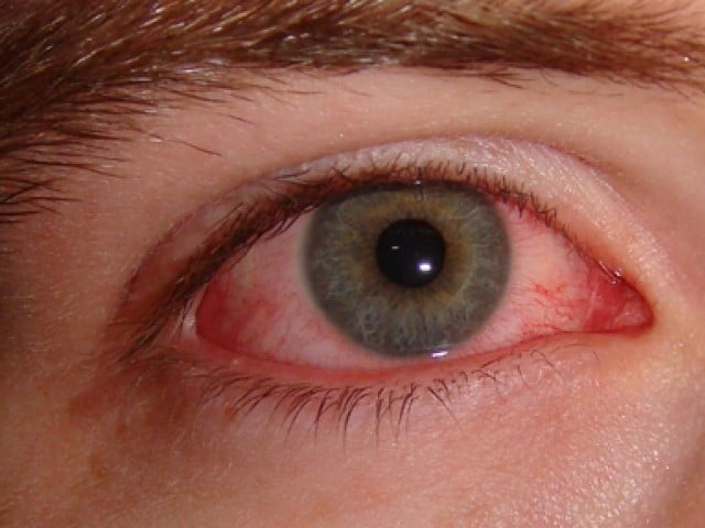 Expert advise public to follow precautionary measures amid rising cases of Pink eye infection