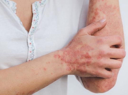 Chronic skin diseases can raise heart disease risk: Study